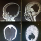 Estas tomografías muestran la evolución del cerebro del niño.